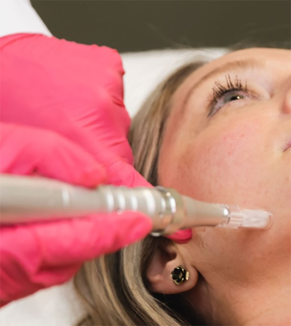 up close of a woman receiving a vampire facial treatment